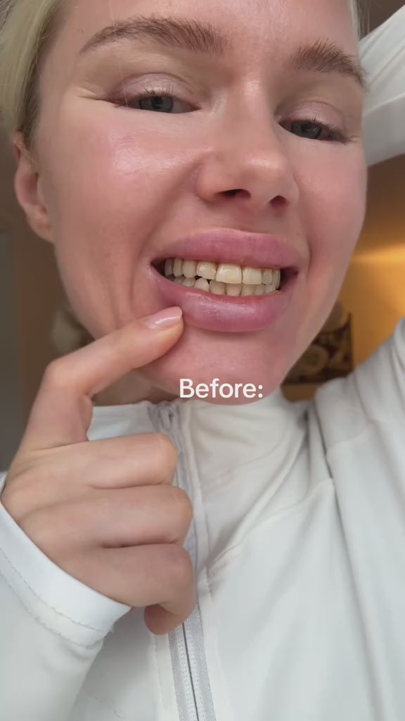 Professional Whitening Kit – Immediate & Long-Lasting Whitening Effect ⭐️🏅